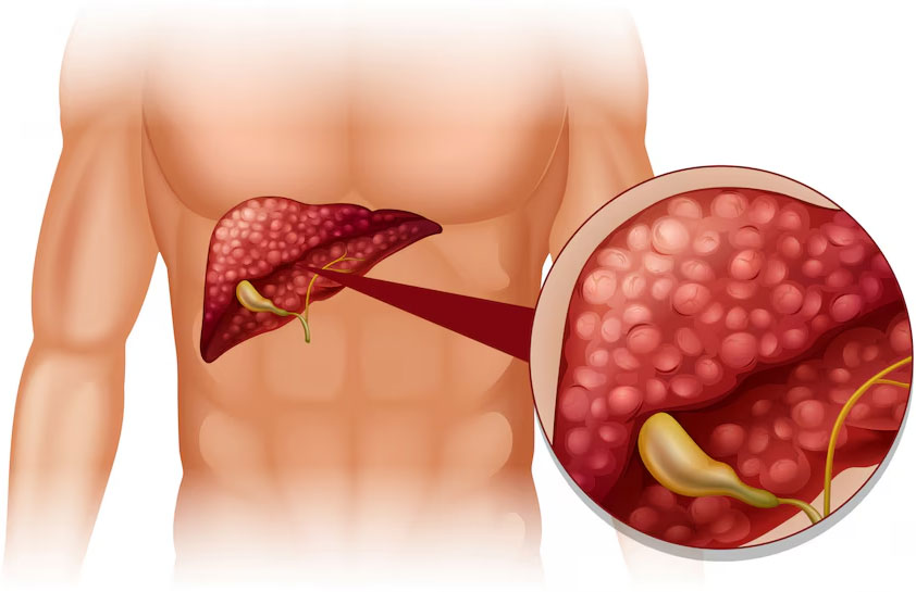 Gallbladder Cancer: What You Should Know